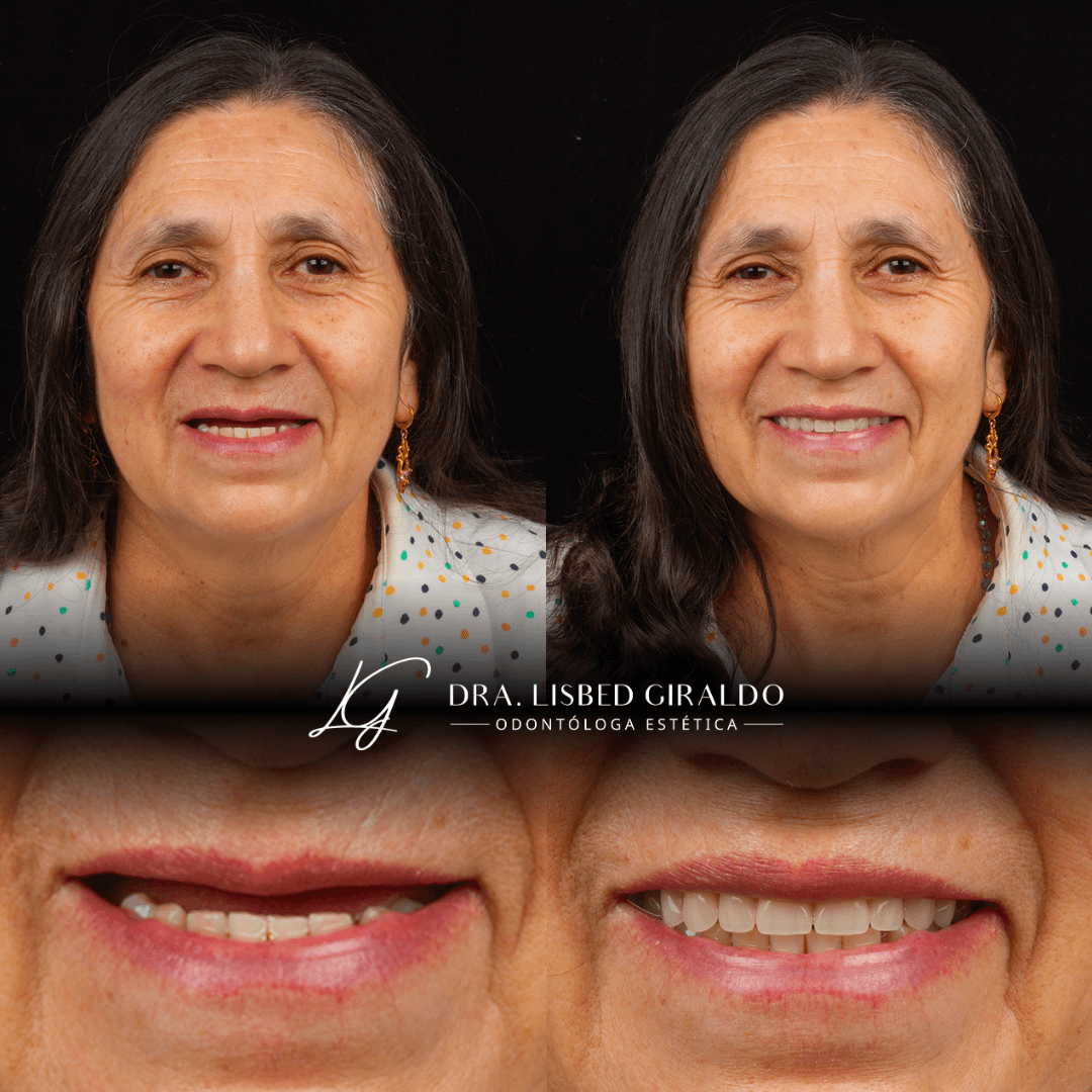Antes y después de una rehabilitación oral con prótesis total: paciente con ausencia de dientes y, después, con una sonrisa completa y natural