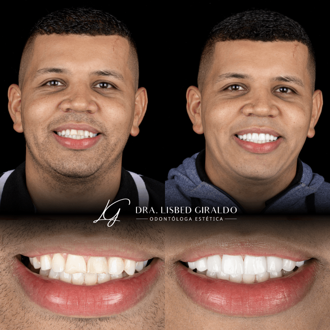 Antes y después de un diseño de sonrisa: dientes desgastados y desalineados y, después, una sonrisa uniforme y armónica