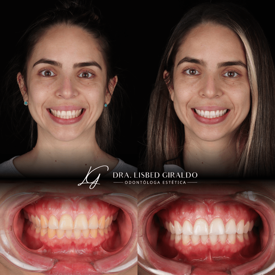 Antes y después de un blanqueamiento dental profesional: dientes con tono amarillento y, después, un tono más claro y uniforme