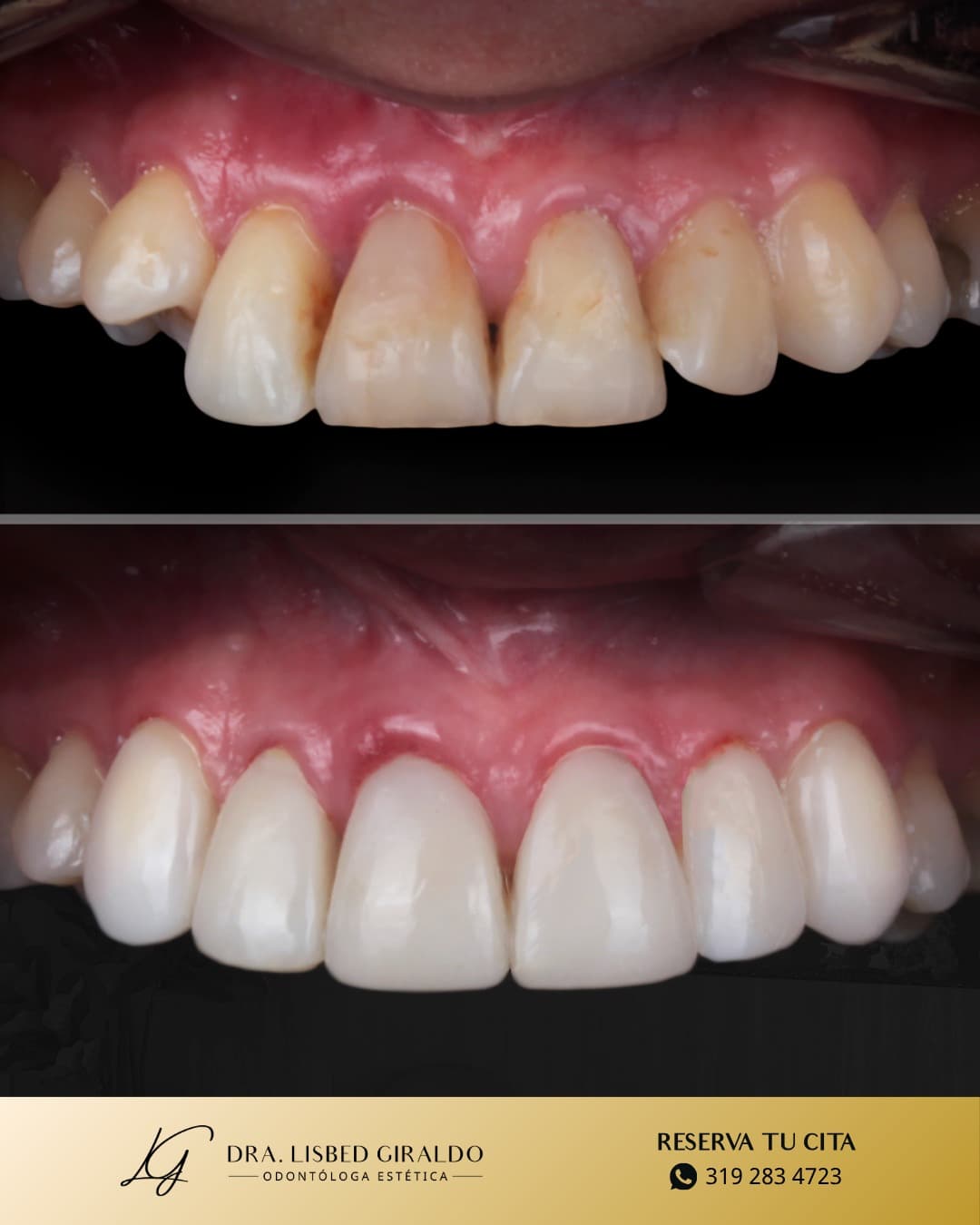 Antes y después de una rehabilitación oral con coronas: dientes desgastados y manchados arriba, dientes restaurados y alineados abajo