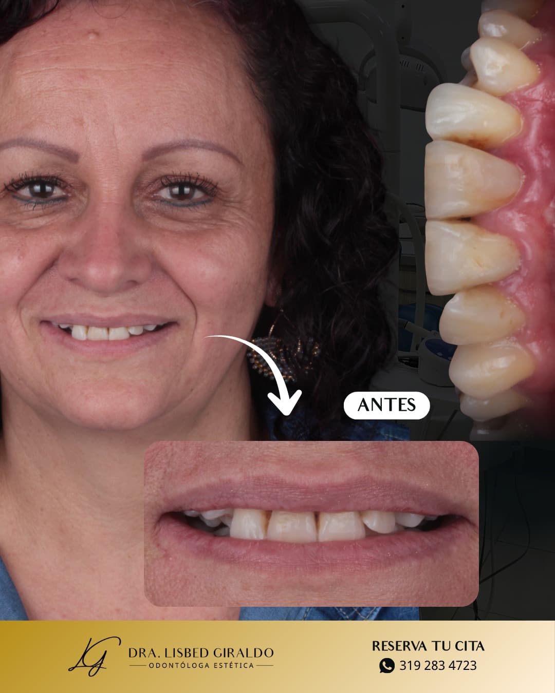 Antes y después de un tratamiento de estética dental de la Dra. Lisbed Giraldo